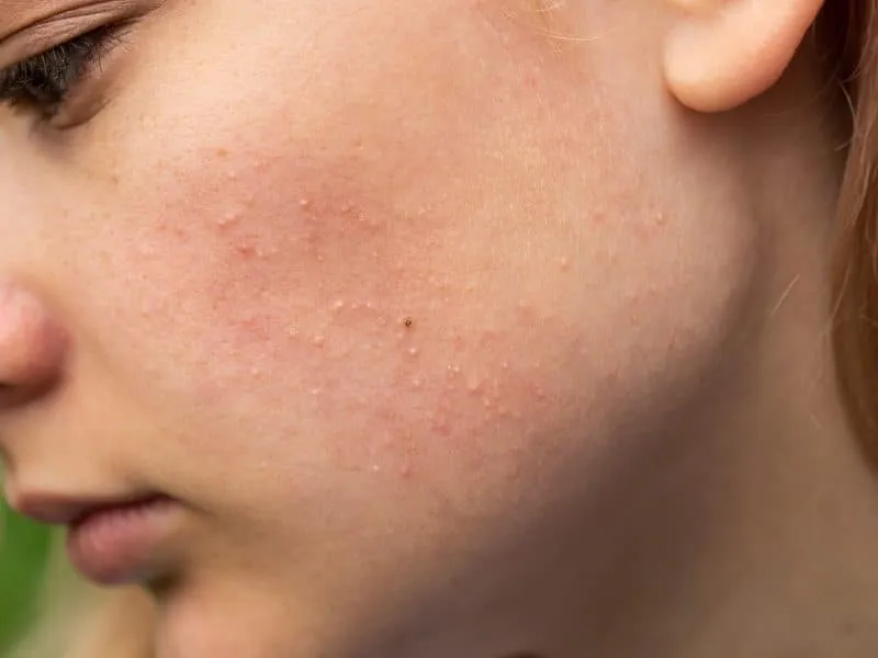 Problematic skin. Acne and red festering pimples on the face of a young girl. Facials for teen girls. Skin care concept.