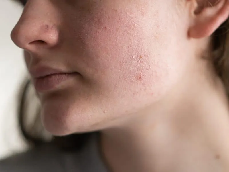 Problem skin face. A teenage girl with a troubled face. Problematic teenage skin. Care for problem skin. Acne remedy. Acne.