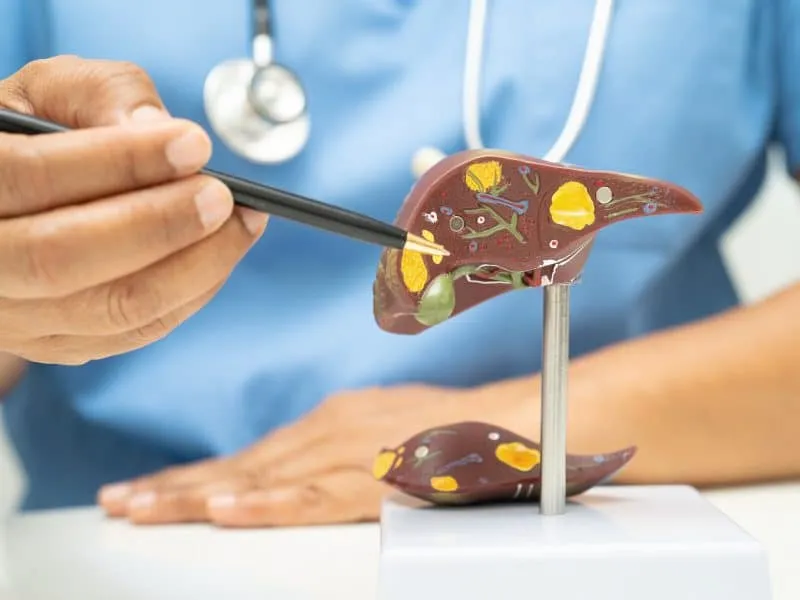 Cirrhosis, Liver cancer, fatty liver, Asian doctor with liver human anatomy model in World Hepatitis Day at hospital.