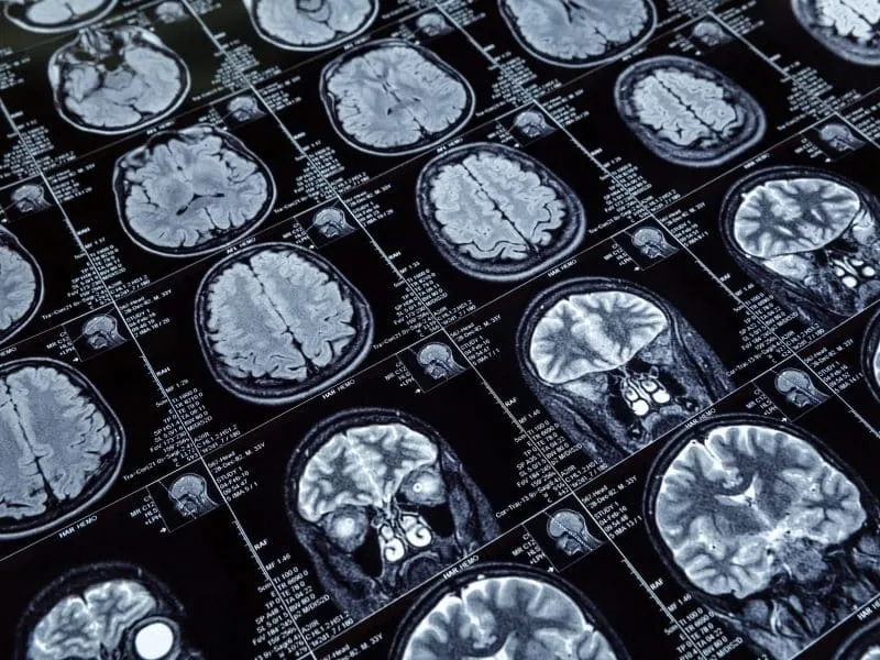 X-ray image of human brain